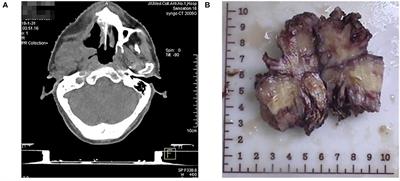 Establishment of a Jaw Fibrosarcoma Patient-Derived Xenograft and Evaluation of the Tumor Suppression Efficacy of Plumbagin Against Jaw Fibrosarcoma